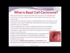 WHAT IS BASAL CELL CARCINOMA? | by Cancer Research Simplified