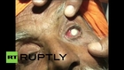 India: See HORRIFIC eye damage in SHOCKING mass botched operation