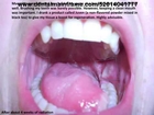 Tongue Cancer, Squamous Cell Carcinoma in Young People, Do you have it Survive It! new
