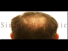 Stop Hair Loss - Hair Regrowth Affirmations Recording by Simply Hypnotic
