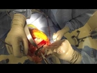 Knee replacement surgery (graphic)