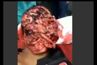 Severe Facial Trauma on Brazilian Man [Graphic]