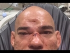 Cyborg's skull fractured by MVP (Worst MMA Injury Joe Rogan ever seen)
