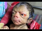 Baby born looking like an 80 year old man