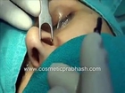 Rhinoplasty Delhi India Big Nose Dorsal Hump Reduction Surgery